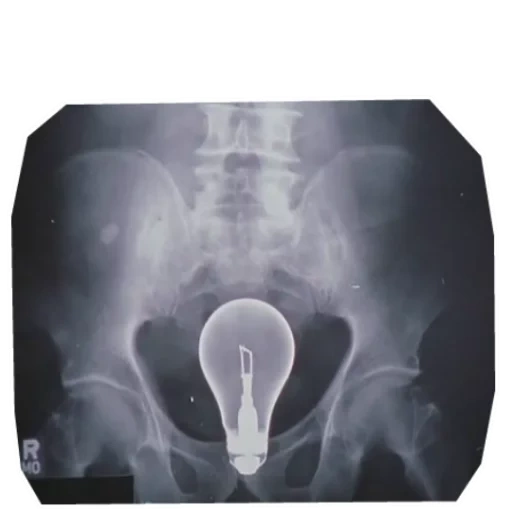 clinic, x ray, hemorrhoids x ray, the organs of the pelvis