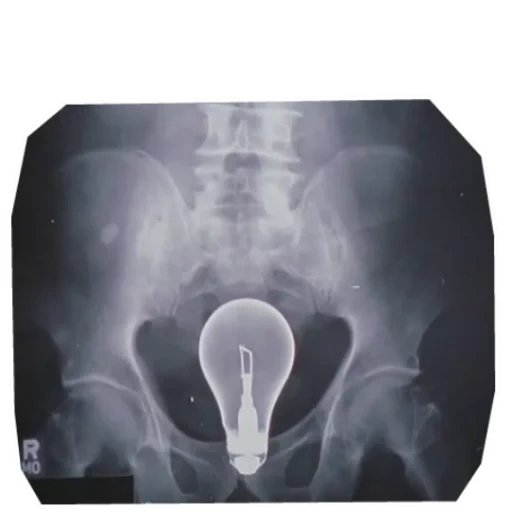 klinik, x ray, hämorrhoiden x ray, die organe des beckens